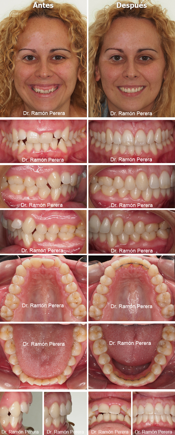 découvrez les traitements du sourire gingival à avignon pour améliorer l'esthétique de votre sourire. solutions personnalisées pour un sourire harmonieux et naturel.