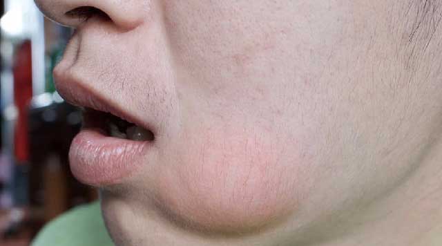 conseils d'expert pour éviter les infections post-opératoires après une intervention chez le dentiste à avignon. assurez une guérison rapide et sans complications.
