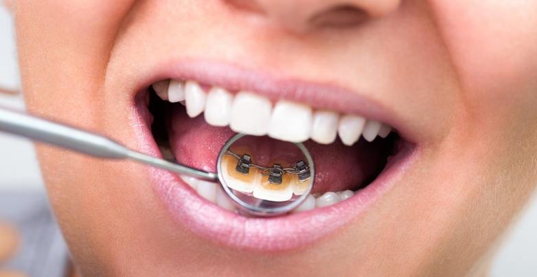 découvrez les avantages d'invisalign et des bagues chez un dentiste à avignon pour choisir le traitement d'orthodontie qui vous convient le mieux.