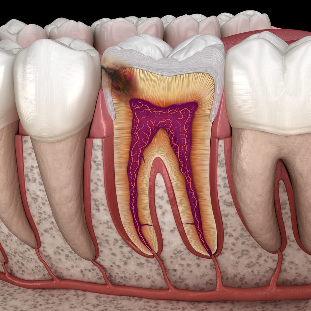 découvrez comment un dentiste à avignon peut détecter rapidement et efficacement les caries pour préserver votre santé dentaire.