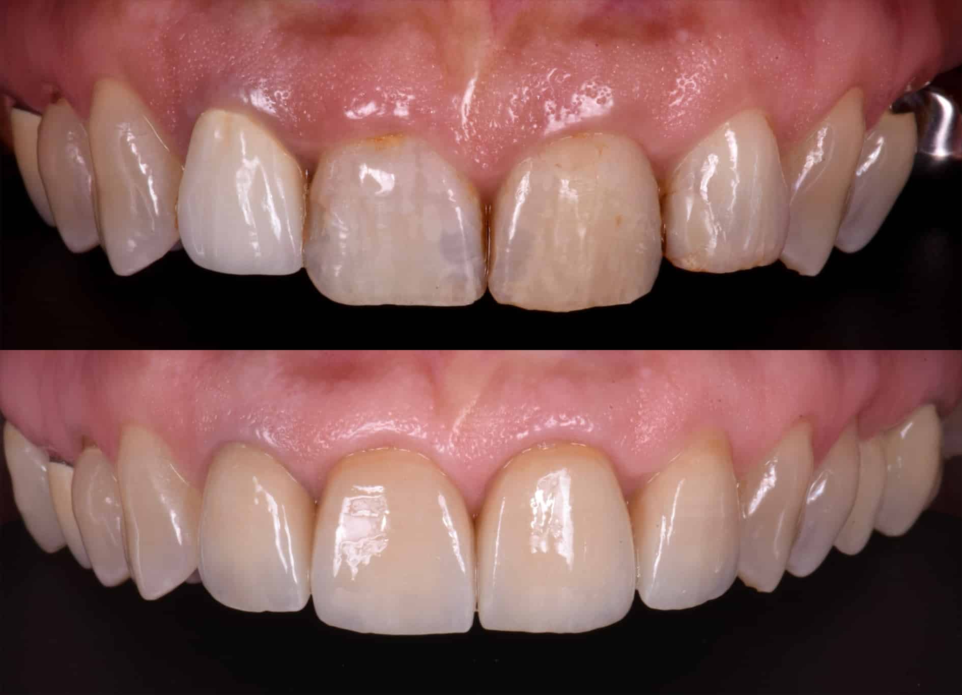 découvrez nos facettes dentaires à avignon pour un sourire éclatant et naturel. solutions esthétiques personnalisées par des experts dentaires locaux.