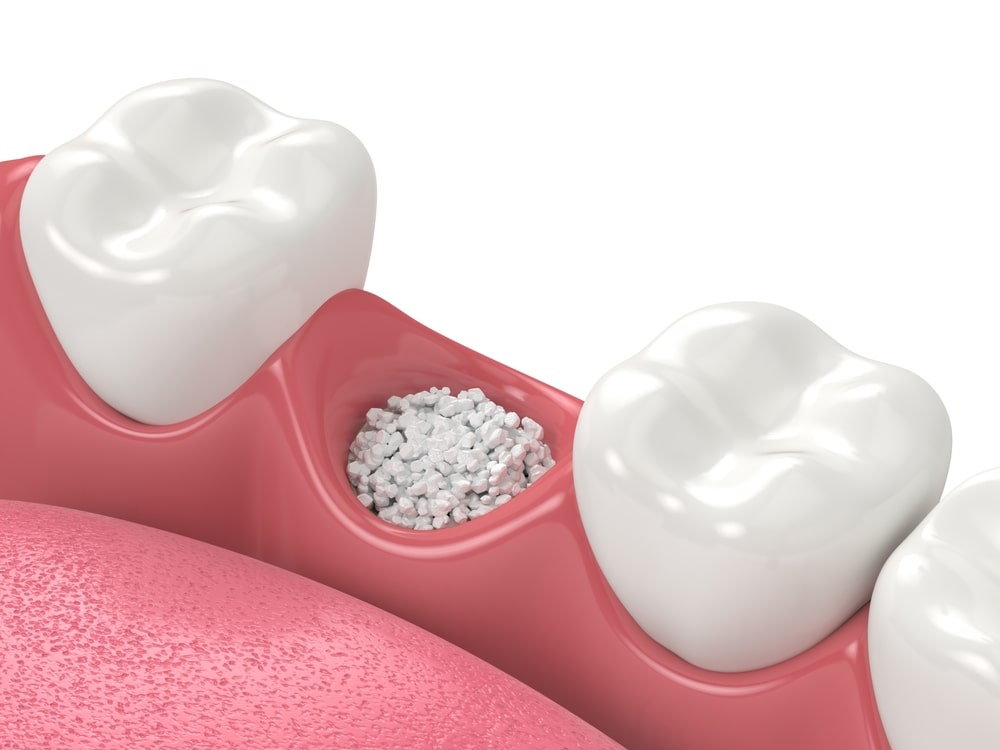 découvrez nos services de greffe osseuse à avignon pour une pose d'implants dentaires optimale. expertise et soins personnalisés par votre dentiste spécialisé.