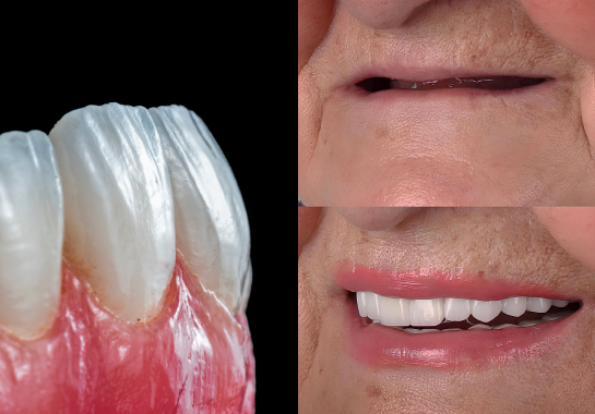 découvrez nos solutions d'implants dentaires à avignon pour un sourire naturel et durable. expertise, confort et résultats garantis près de chez vous.