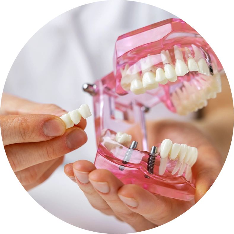 découvrez nos implants dentaires à avignon pour un sourire éclatant et une restauration dentaire durable. expertise et soins personnalisés près de chez vous.