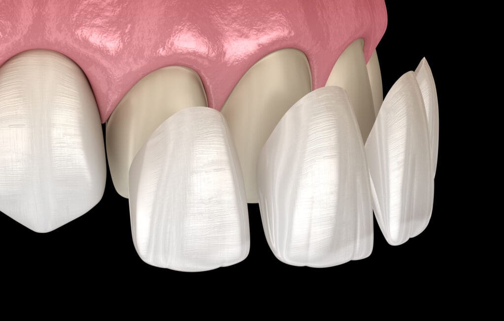 découvrez la pose de facettes dentaires à avignon avec nos dentistes experts pour un sourire éclatant et naturel. rendez-vous dès aujourd'hui pour une consultation personnalisée.