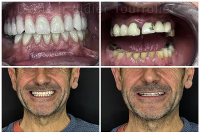 découvrez nos solutions de remplacement de dents manquantes à avignon pour retrouver un sourire éclatant et une mastication efficace. prenez rendez-vous avec nos spécialistes dentaires dès aujourd'hui.