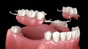 découvrez les solutions efficaces pour remplacer une dent manquante à avignon. prothèses, implants dentaires ou bridges, trouvez le traitement adapté à vos besoins.