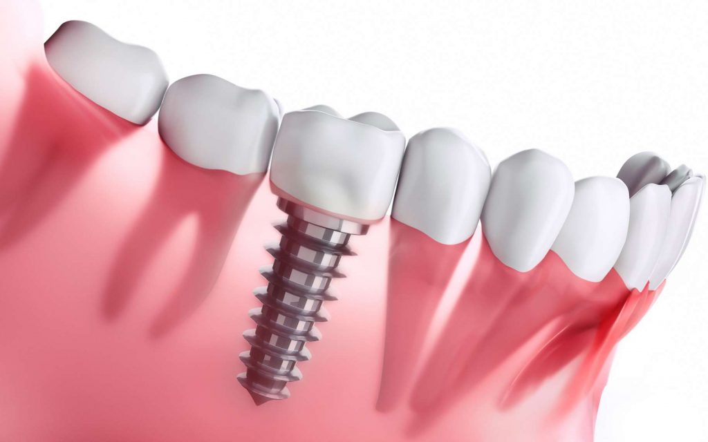 découvrez nos soins prothétiques dentaires à avignon, alliant expertise et innovation pour un sourire éclatant et un confort optimal.