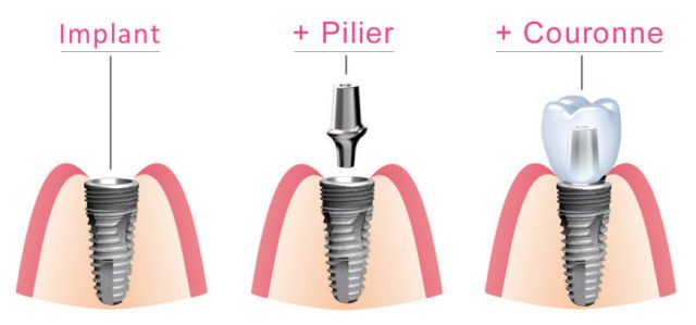 suivi personnalisé après implantation dentaire à avignon pour assurer la réussite et la santé de votre implant.