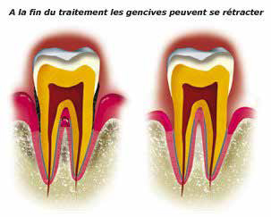 découvrez les traitements efficaces de la récession gingivale à avignon pour préserver la santé de vos gencives et améliorer votre sourire. consultez nos spécialistes dès aujourd'hui.